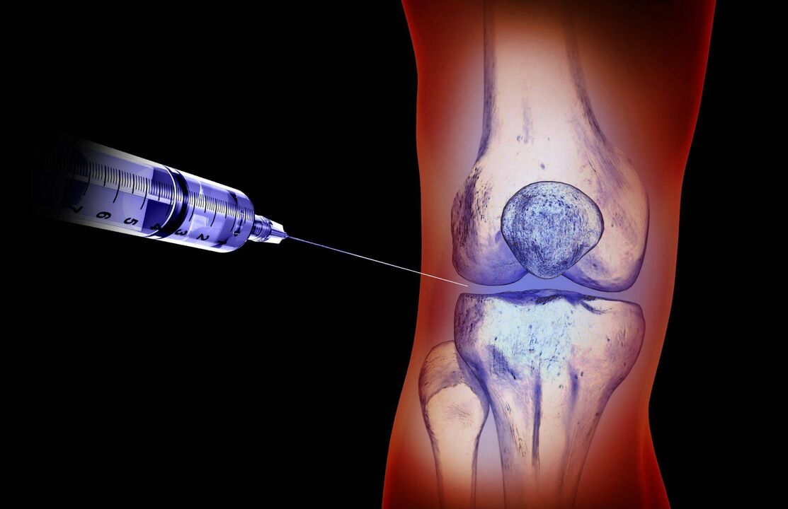 intra-articular injections alang sa arthrosis