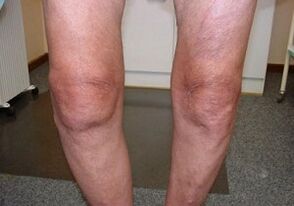 Giunsa pagtratar ang arthrosis sa tuhod nga hiniusa
