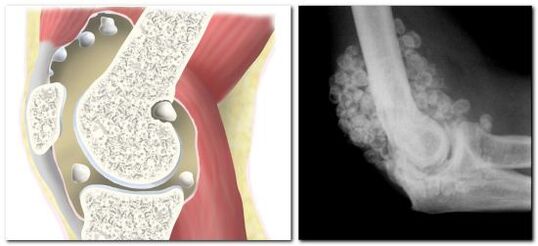 chondromatosis nga adunay kasakit sa hip joint
