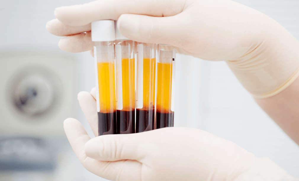 Platelet-rich plasma alang sa PRP therapy alang sa arthrosis